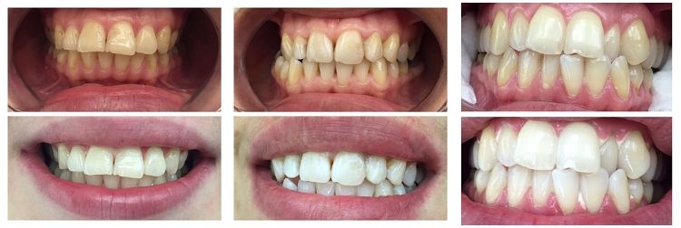 Best In Office Teeth Whitening Treatment