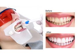 Быстрое отбеливание зубов для моих клиентов